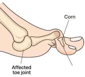 hammertoe foot condition