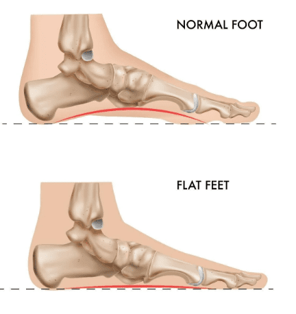 flat feet foot condition