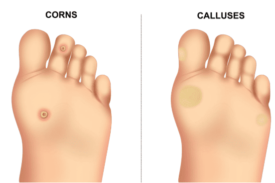 corns and calluses foot condition