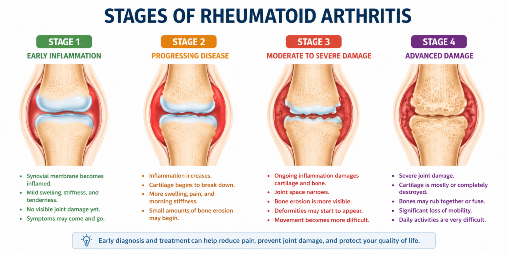 stages of rheumatoid arthritis with an explanation on what happens to the bones