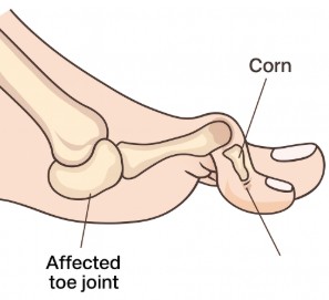 hammertoe foot condition