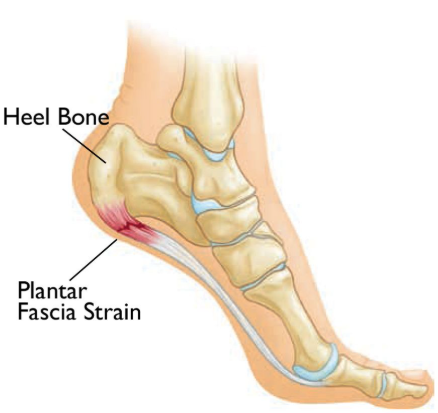 plantar fasciitis foot condition