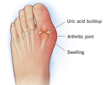 gout foot condition